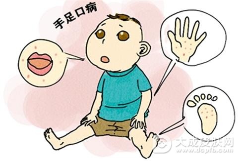 手足口病是什么,有哪些症状表现