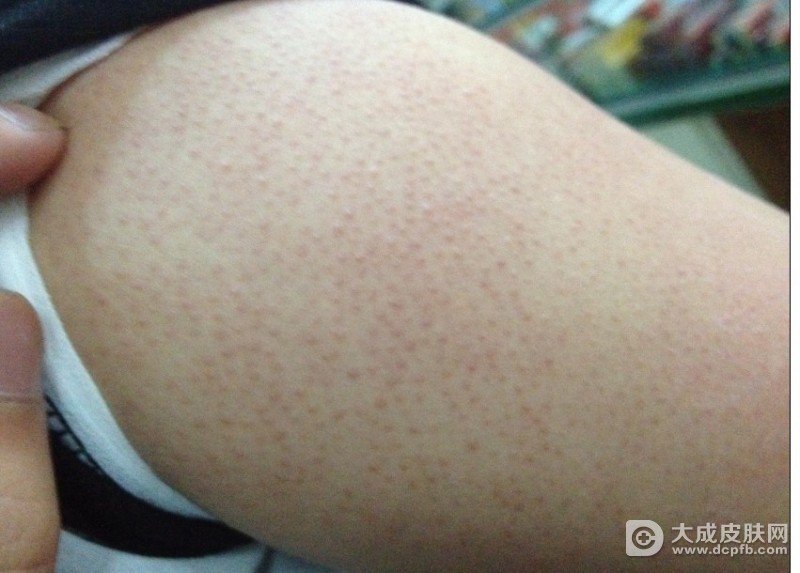 毛周角化症的原因有哪些