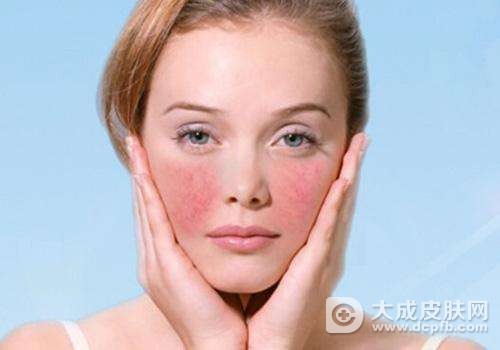 改善脸部过敏性皮炎该怎么护理