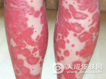 红皮病型牛皮癣