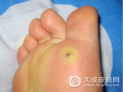 鸡眼和老茧你还傻傻分不清楚吗