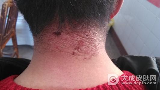 神经性皮炎的发病原因和预防方法