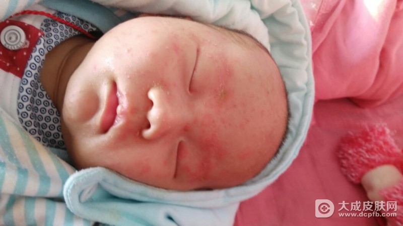 宝宝湿疹反复发作该怎么护理
