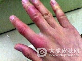 冬季将到,提前预防冻疮是关键