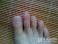 引起灰指甲的因素有哪些