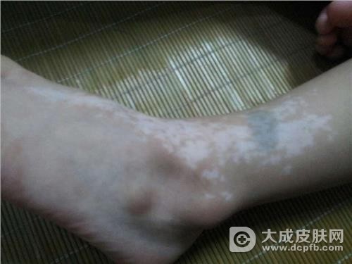 两条腿上有白斑怎么回事