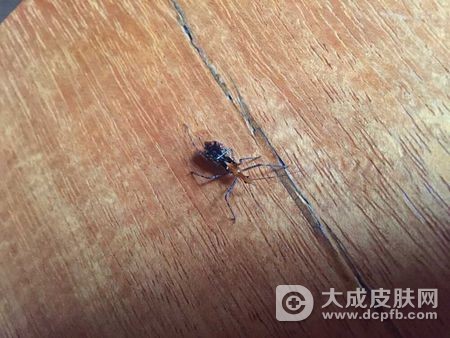 七旬老太被虫子叮咬后感染,险丢性命
