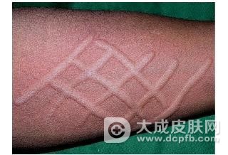 导致荨麻疹的过敏原有哪些