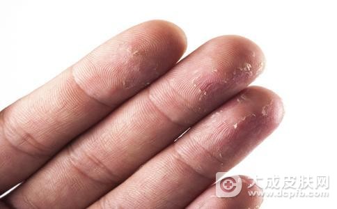 手爱脱皮或是这六种因素