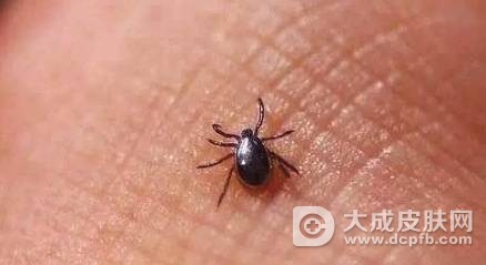 老太被虫咬后 竟患罕见的“新布尼亚病毒”