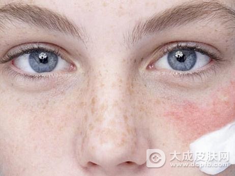 女子用“天价”护肤品 脸上过敏竟更严重