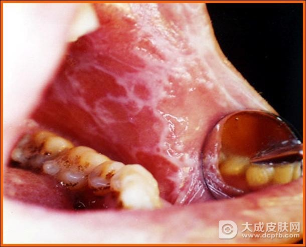 口腔扁平苔藓有哪些发病因素