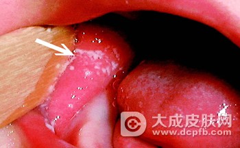 小儿爱患鹅口疮 提前预防是关键