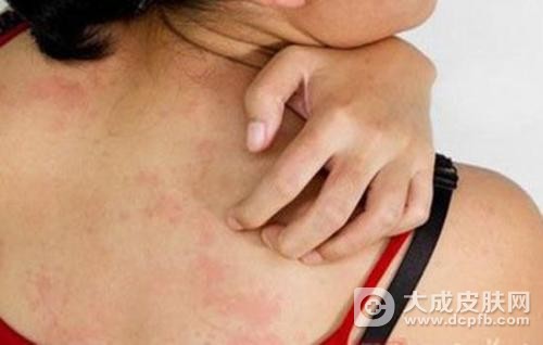 68岁婆婆洗澡洗出瘙痒症