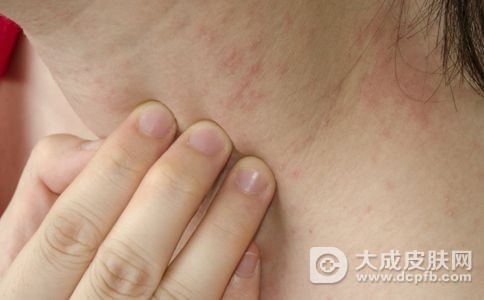 得了皮肤过敏性湿疹日常该怎么护理