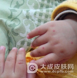 什么是手足口病 该如何预防