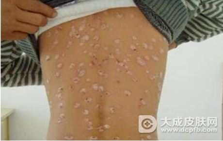 体癣有哪些症状表现