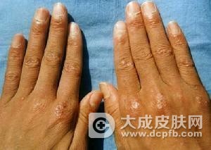 皮肌炎危害大 影响皮肤和健康