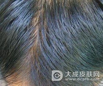 女子用生发产品导致头皮出现皮肤病