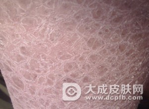 4岁女孩患先天性鱼鳞病 全身皮肤干裂似鱼鳞