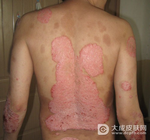 各类牛皮癣的症状表现