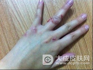 改善手部湿疹偏方 让你摆脱困扰