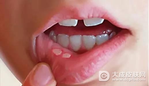 男孩口腔反复溃疡 竟是患了这种病