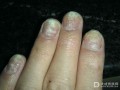 灰指甲的种类有哪些