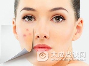 长痘太烦恼 去痘教你四大招