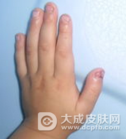 宝宝感染灰指甲后该怎么护理