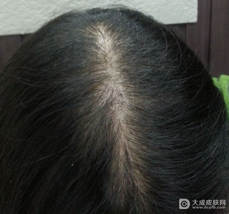 用生发产品 头发没密反而出现皮肤病