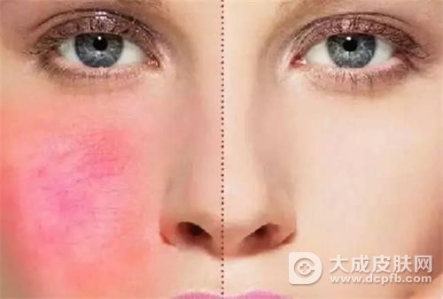 出现遗传性红血丝该怎么办