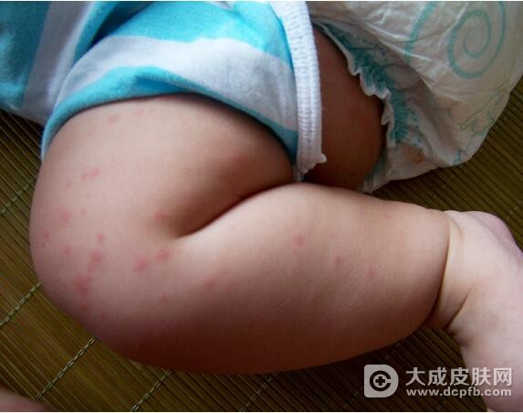 宝宝得了过敏性荨麻疹怎么办