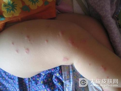 冬季预防荨麻疹 教你五招
