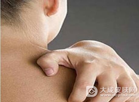 冬季瘙痒莫搔抓 小心丢性命