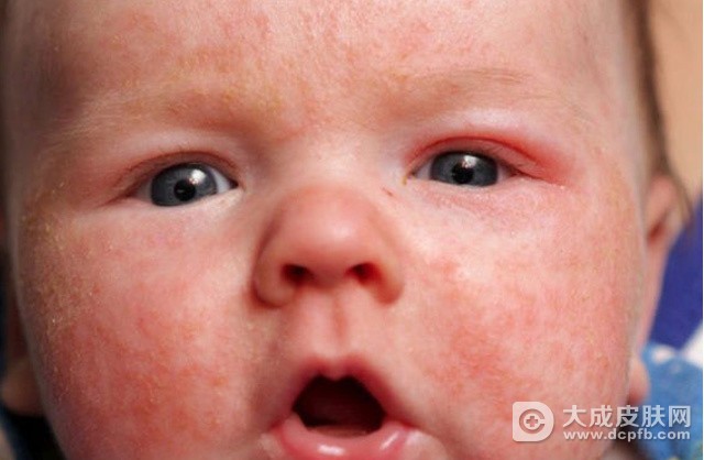 冬季引发宝宝湿疹的原因有哪些