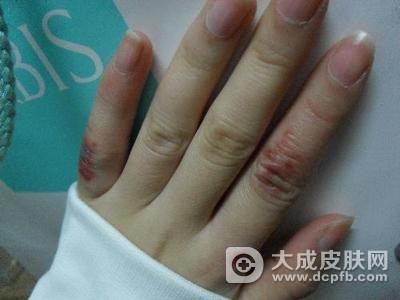 冬季高发冻疮 教你治冻疮偏方
