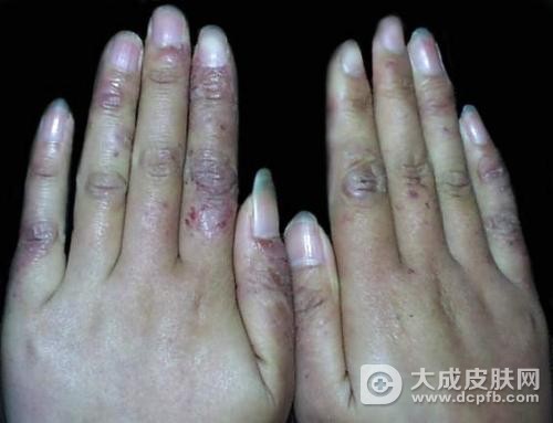 防治冻疮 教你六个妙招