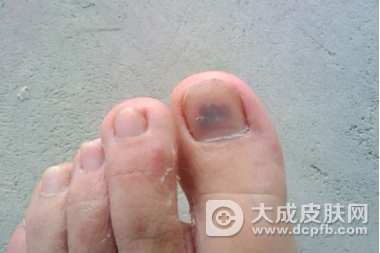 灰指甲有哪些病因。