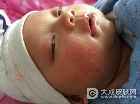 改善小儿湿疹 教你有效方法