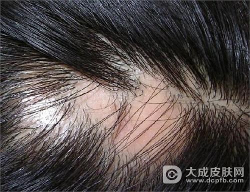 造成鬼剃头的原因有哪些