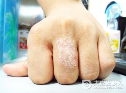 冬季湿疹出现有哪些原因