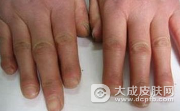 硬皮病患者为什么不能多吃水果?