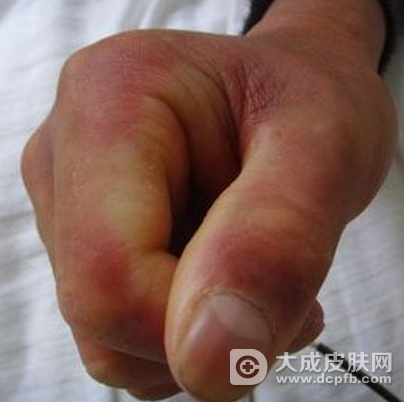 硬皮病患者为什么不能多吃水果?