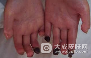 硬皮病患者为什么不能多吃水果?