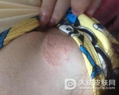 体癣和牛皮癣本质上的区别