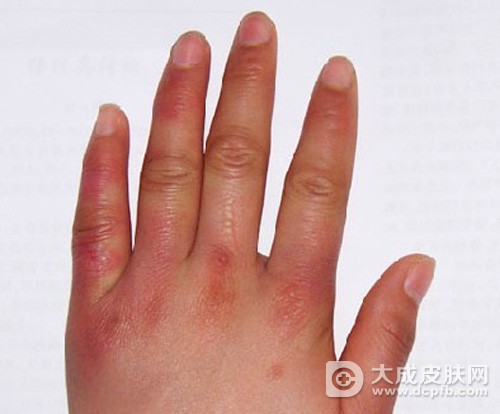 预防冻疮的五个方法