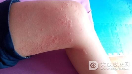 青岛荨麻疹的危害