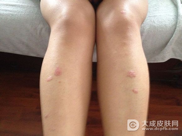 银屑病患者日常怎么护理