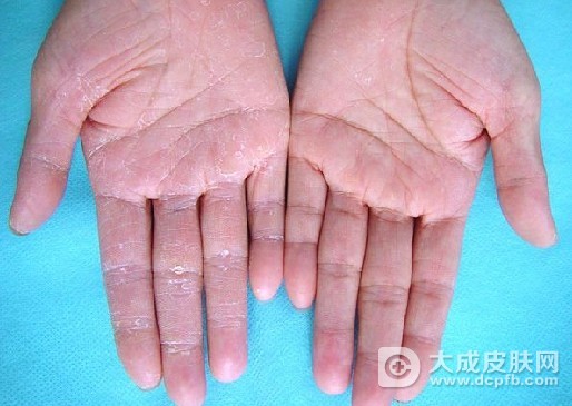 鹅掌风会传染吗 怎么护理